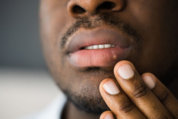African American man with herpes on his lip